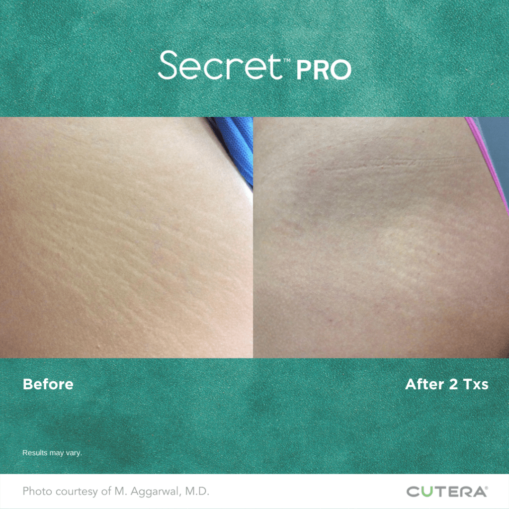 stretch mark removal