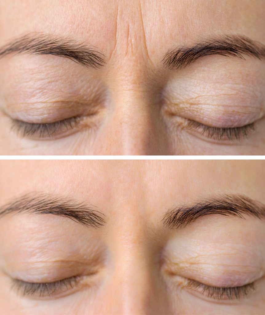 Top and bottom images show a forehead with eyes closed, displaying visible horizontal lines above the eyebrows