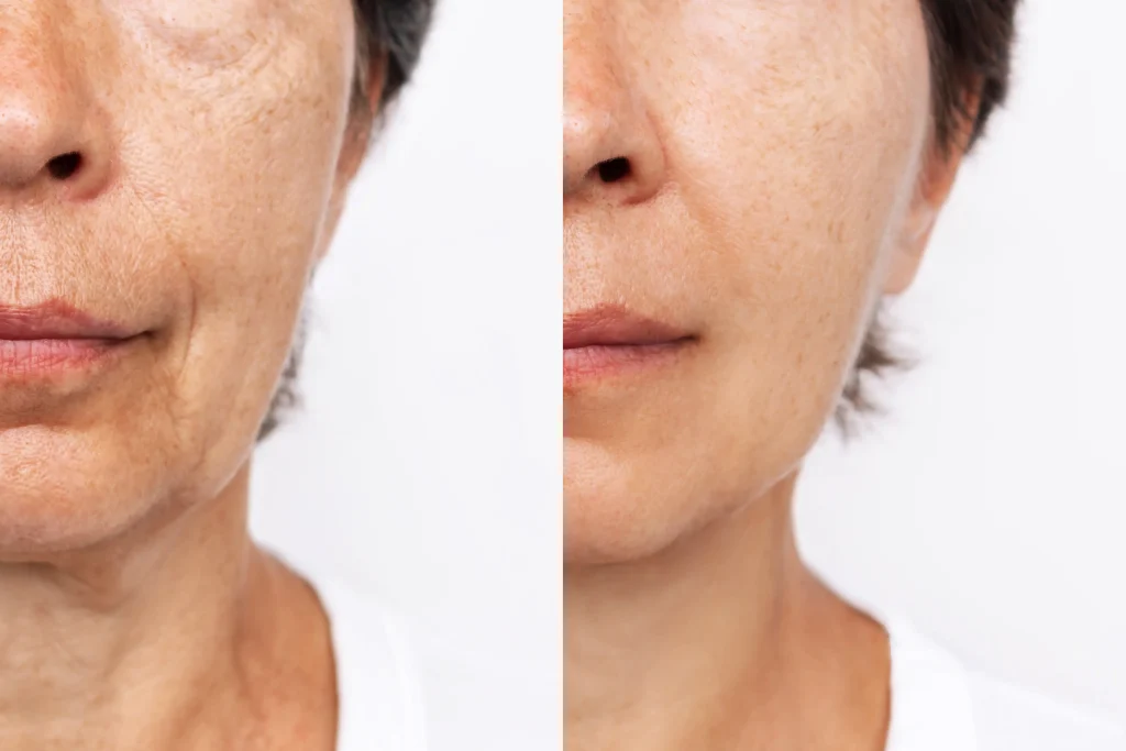 Side-by-side facial skin comparison showing visible lines and smoother texture