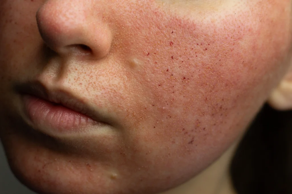 Close-up of cheek with redness and visible skin texture after treatment