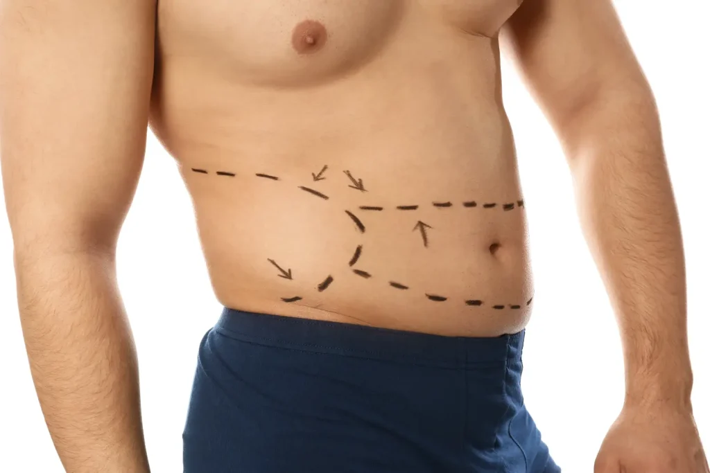 Male torso with dashed surgical markings and arrows drawn across the abdomen and waist.